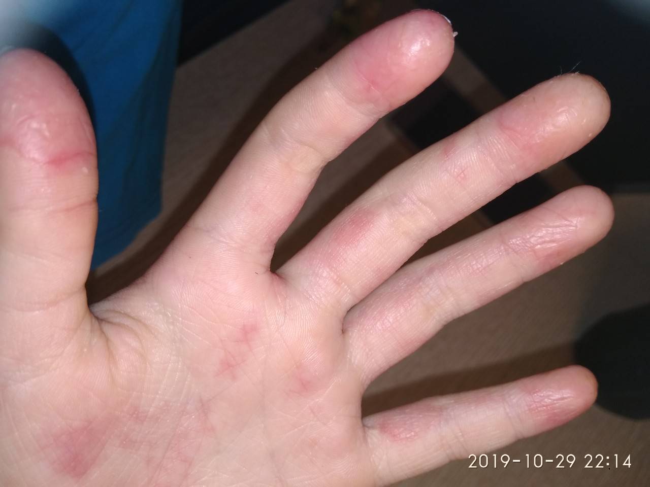 Почему облазит кожа на пальцах рук у ребенка и взрослого