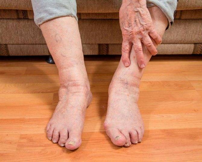 Ночные судороги ног у женщин пожилого возраста лечение