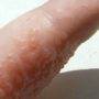 Водянистые пузырьки на коже: фото, причины, лечение | заболевания кожи