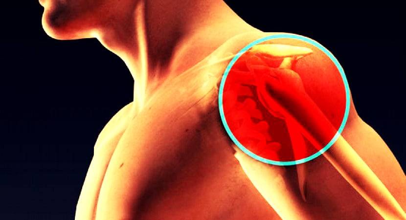 Что такое синовит плечевого сустава и как лечить заболевание?