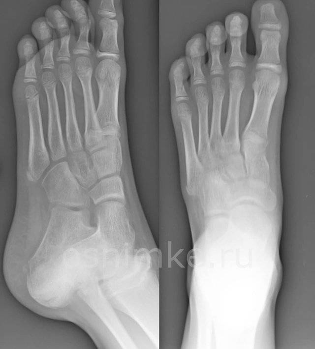 Рентген стопы – что показывает, в каких проекциях делают. рентген с нагрузкой (в двух проекциях, для военкомата). выявление патологии пальцев, костей, суставов, мышц, связок и сухожилий стопы (фото)