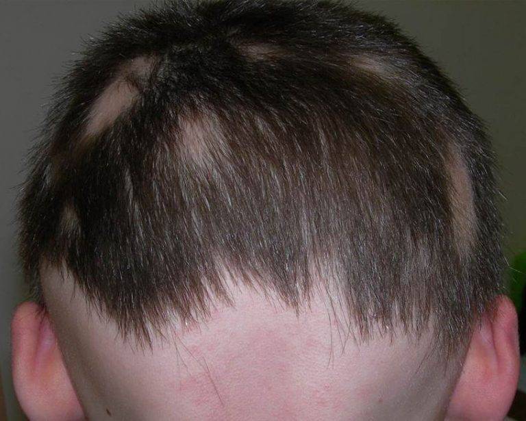 Стригущий лишай на голове у ребенка: фото начальной стадии, признаки, лечение микроспории