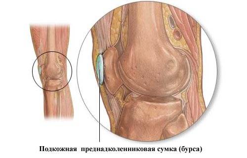 Супрапателлярный бурсит коленного сустава: что это такое, симптомы и лечение