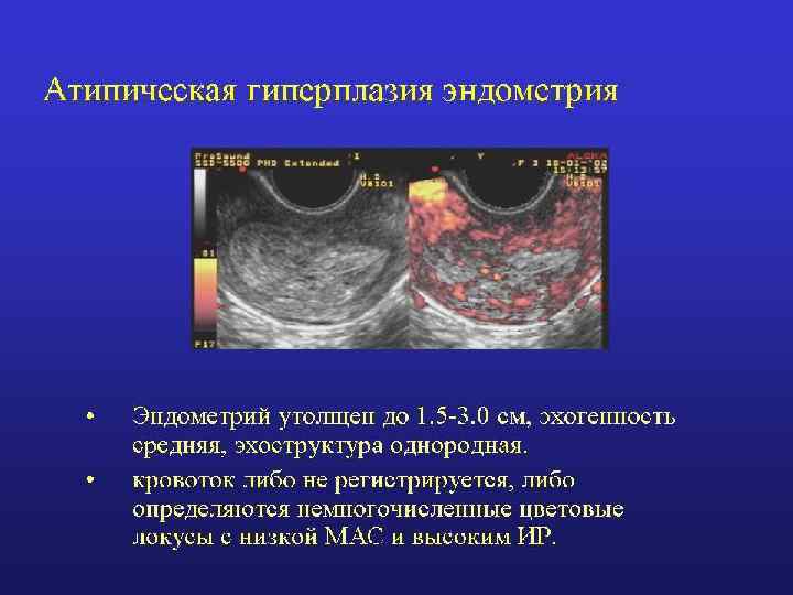 Лечение гиперплазии эндометрия