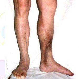 Что такое и как лечить воспаление (тромбофлебит) глубоких и поверхностных вен на ногах