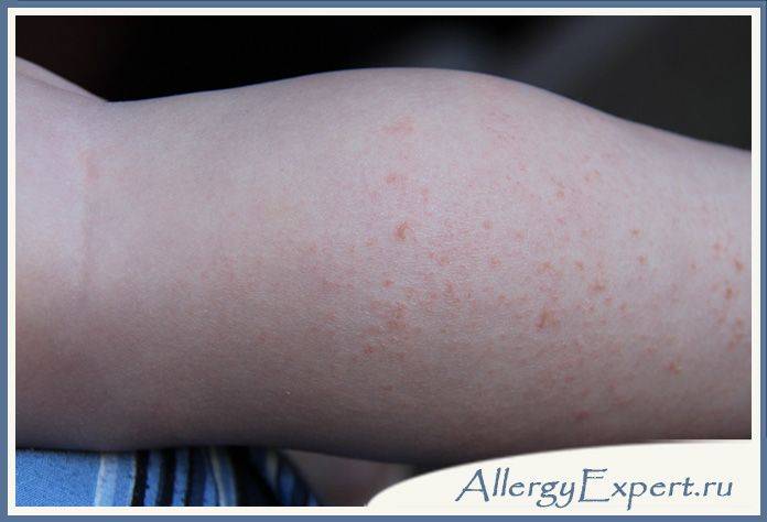 Аллергия на руках у детей и взрослых: что делать, причины, лечение, препараты, фото