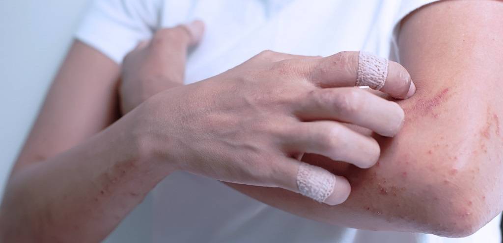 Цыпки на руках: 25 действенных способов лечения, фотографии заболевания