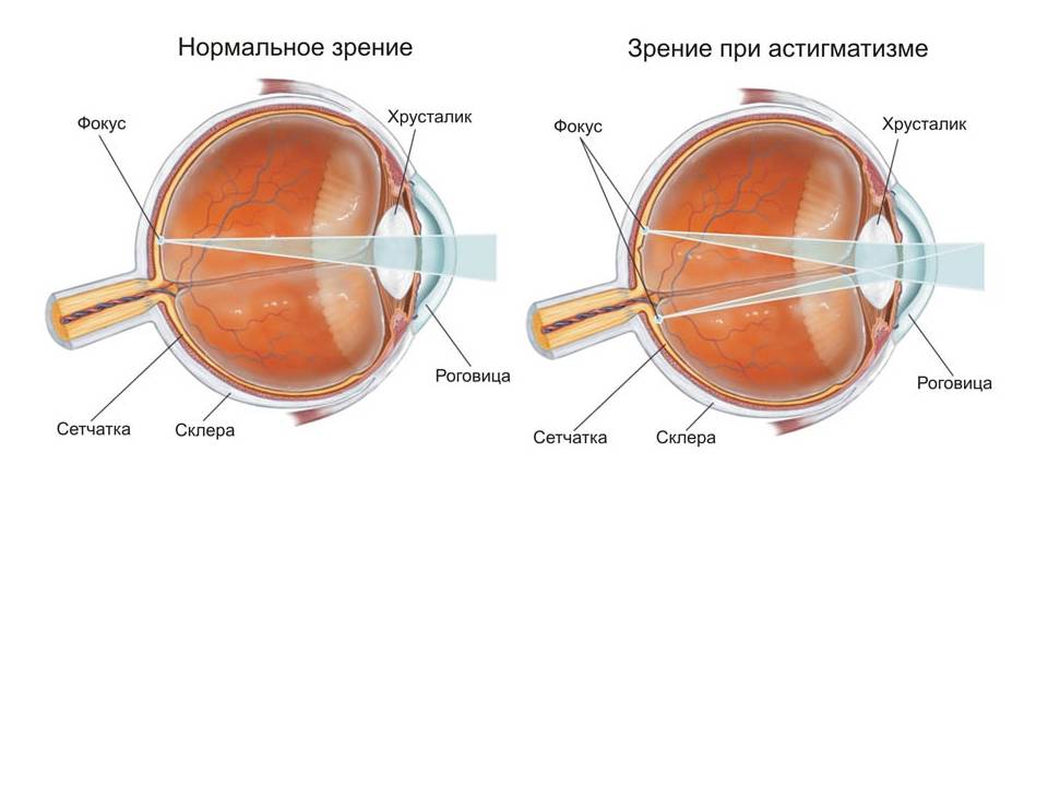 Что такое сложный миопический астигматизм. Дефекты зрения астигматизм. Астигматизм хрусталика глаза. Хрусталик глаза человека.