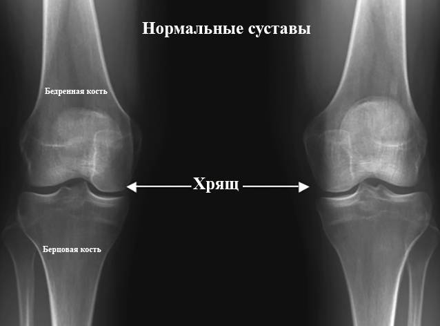 Рентген колена. Мениск коленного сустава рентген. Коленный сустав рентген норма. Менископатия коленного сустава рентген. Рентген нормального коленного сустава.