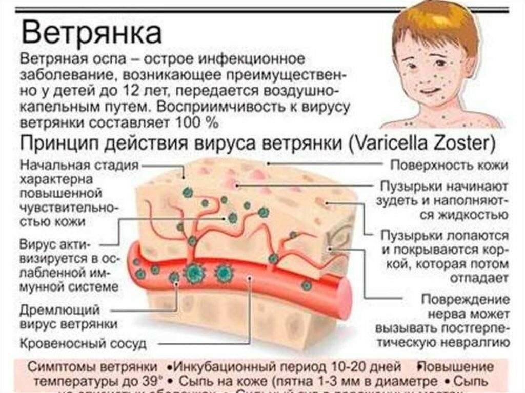 Как выглядит сыпь при энтеровирусной инфекции у ребенка на фото и как ее лечить?