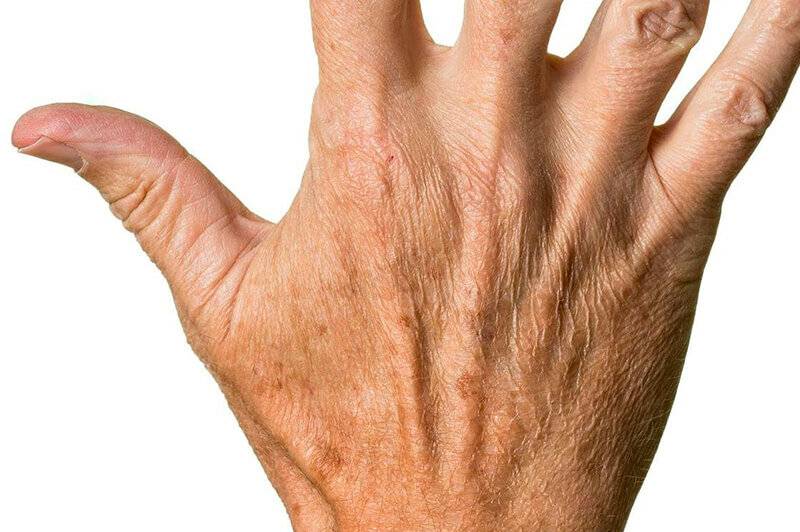 Как вывести пигментные старческие пятна на руках?