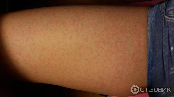 Аллергия на коже - красные пятна чешутся, лечение мазью