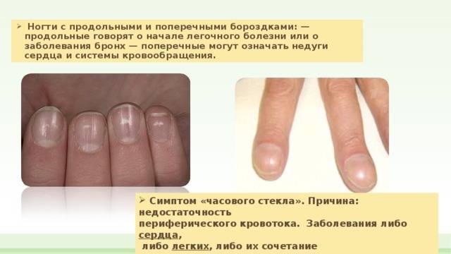Причины появления полосок на ногтях