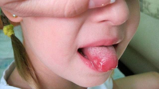 Как вылечить молочницу во рту у младенца?