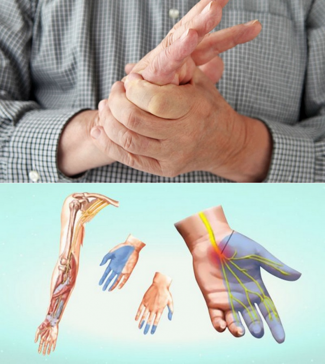 Химиотерапия немеют пальцы. Кисть руки. Парестезия конечностей.