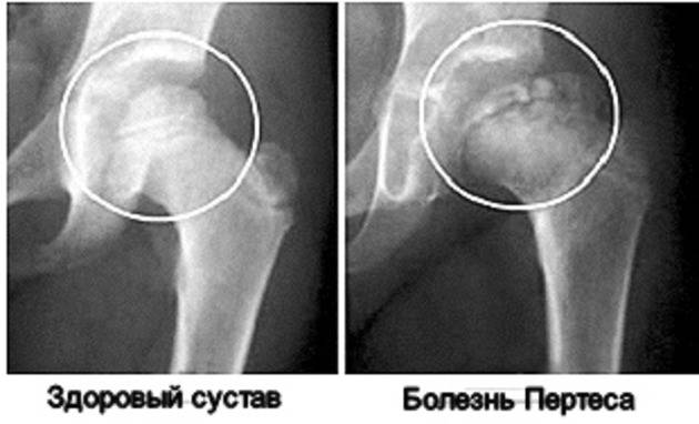 Болезнь кенига коленного сустава: лечение рассекающего остеохондрита у детей и взрослых, причины болезни у спортсменов, народные средства