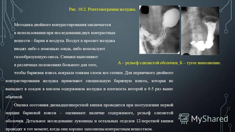 Подготовка к рентгену желудка - ход процедуры, особенности и противопоказания