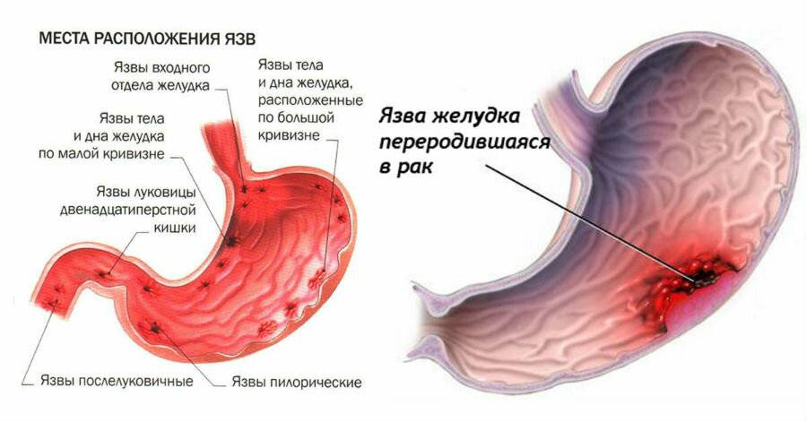 Признаки гастрита желудка на ранней стадии у женщин