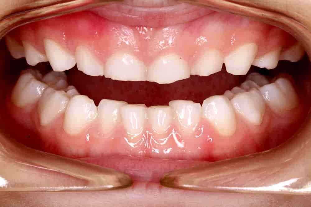 Бруксизм: признаки и лечение – стоматология президент