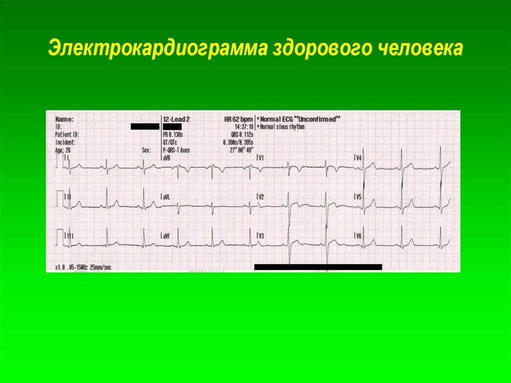 Классификация синусового ритма: что может рассказать кардиограмма о состоянии сердца?