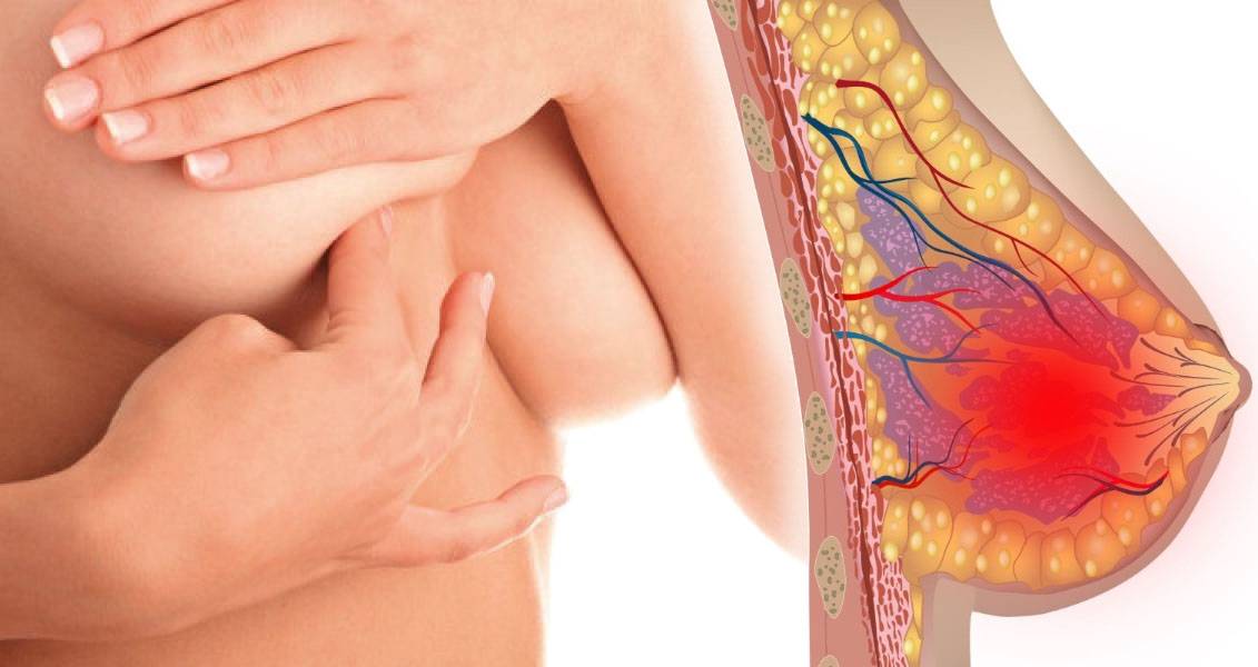 Лечение мастопатии у женщин после 50 лет + симптомы данной патологии, причины ее возникновения при климаксе и методы диагностики