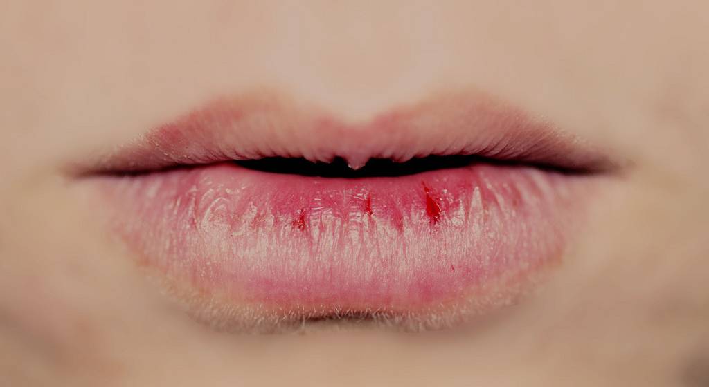 Шелушатся губы: причины, дополнительные симптомы, лечение, профилактика