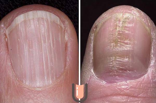 Причины ребристых ногтей на руках – почему ногти в полосочку и как это лечить