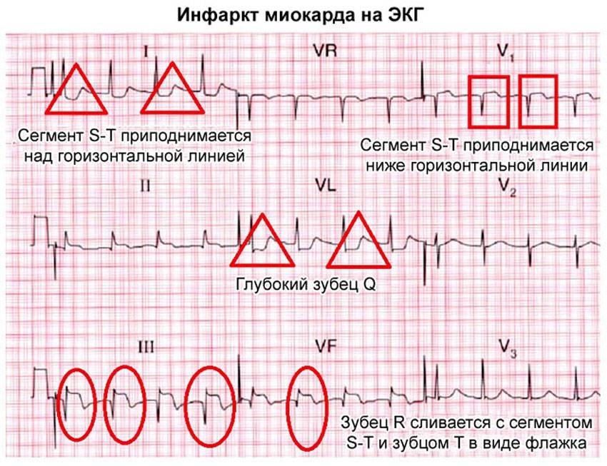 Первые признаки инфаркта миокарда - симптомы и лечение. журнал медикал