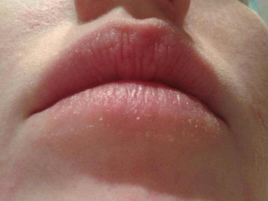 Шелушится кожа вокруг рта: лечим в домашних условиях
