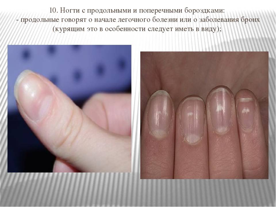 Почему появляются продольные полосы на ногтях