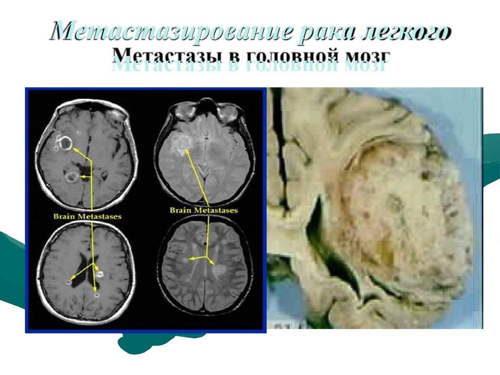 Метастазы в головной мозг при раке легких: особенности и возможности выздоровления