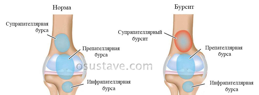 Супрапателлярный и инфрапателлярный бурсит коленного сустава