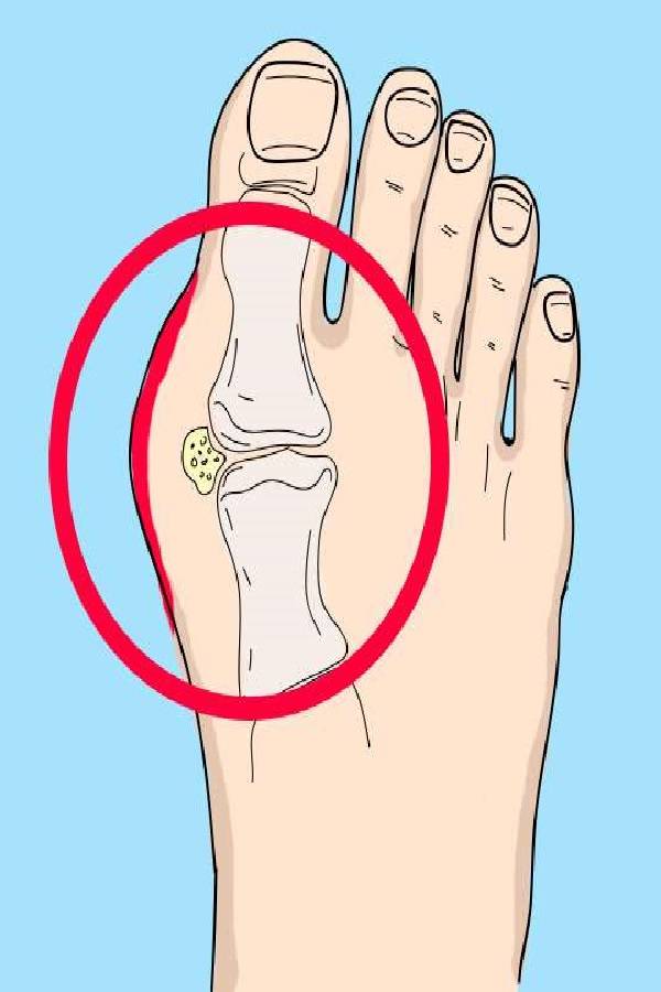 Что делать, если болит сустав большого пальца на ноге