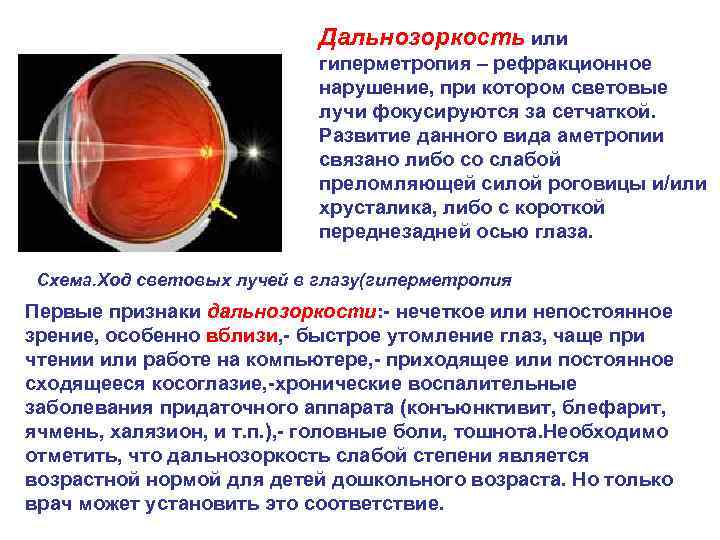 Гипертрофия глаза у ребенка – гиперметропия слабой степени