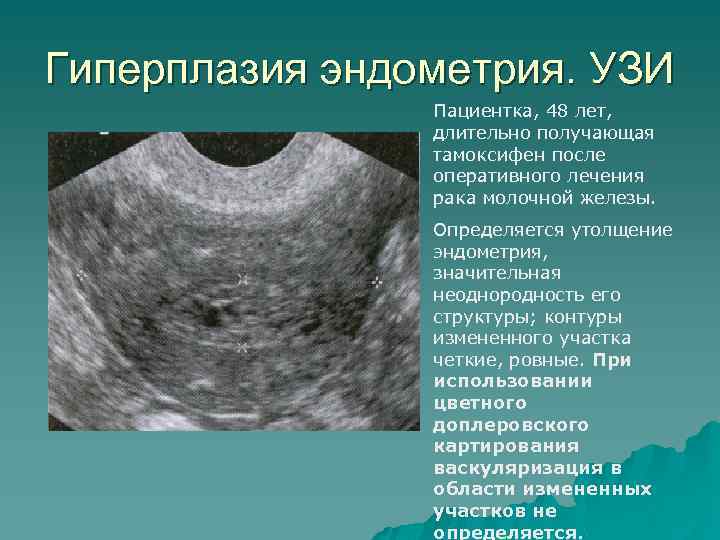 Серозометра при раке шейки матки - здоровье и гигиена