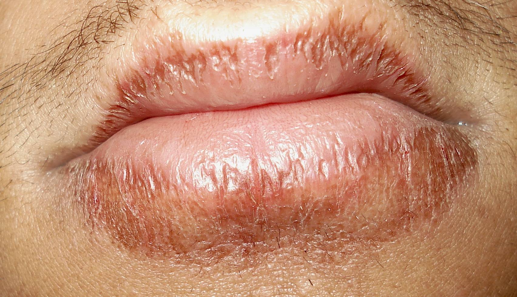 Шелушится кожа вокруг рта: ищем причины, устраняем косметический дефект