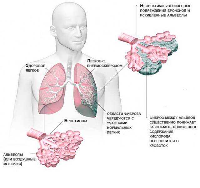 Фиброз после пневмонии: что это такое, как выглядят тяжи и рубцы на легких и обратимы ли изменения, а также симптомы, диагностика, лечение заболевания и прогноз