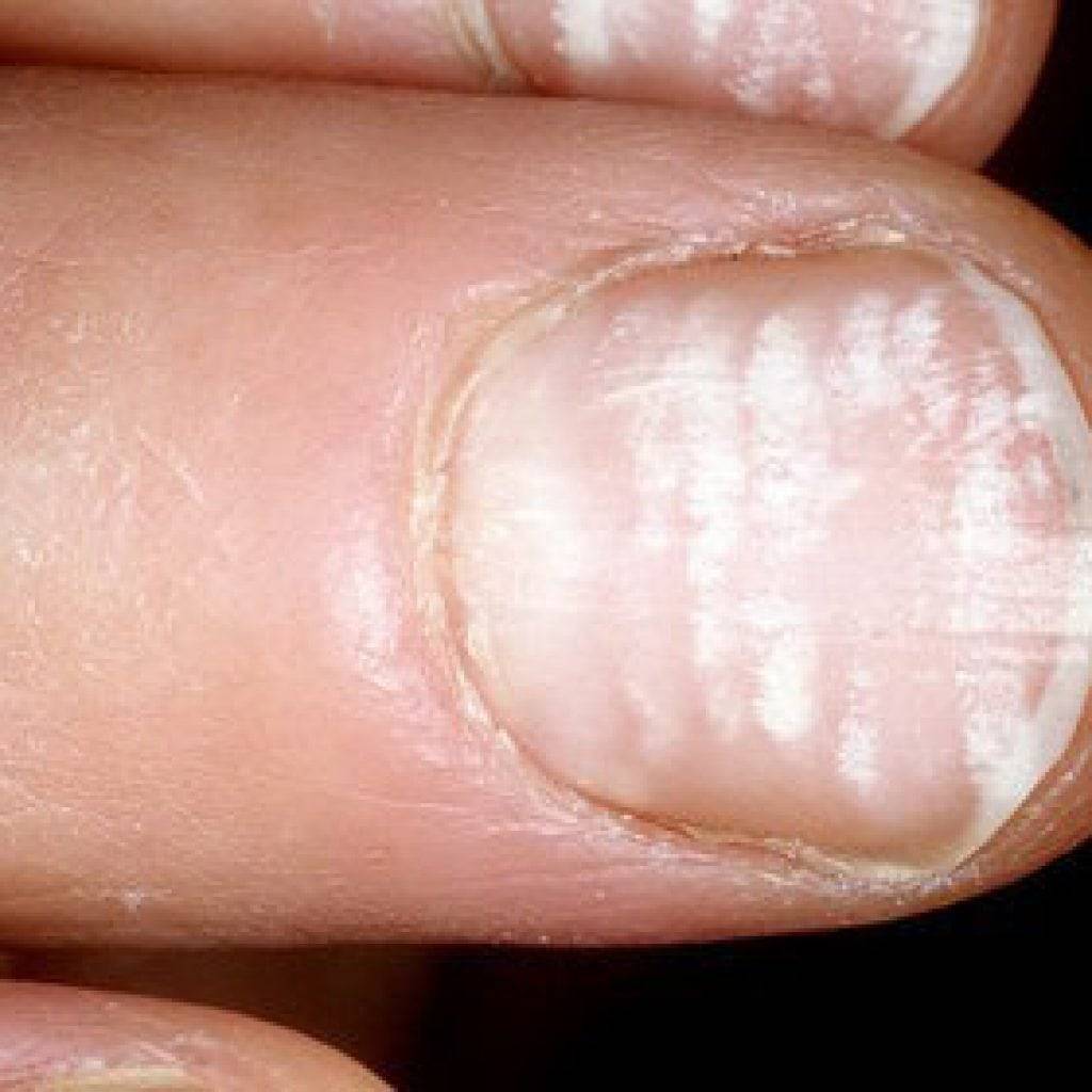 Почему чернеют ногти на ногах у женщин: причины и лечение ногтей — секреты красоты