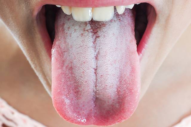 Язык обложен белым налетом: симптомы, причины и лечение