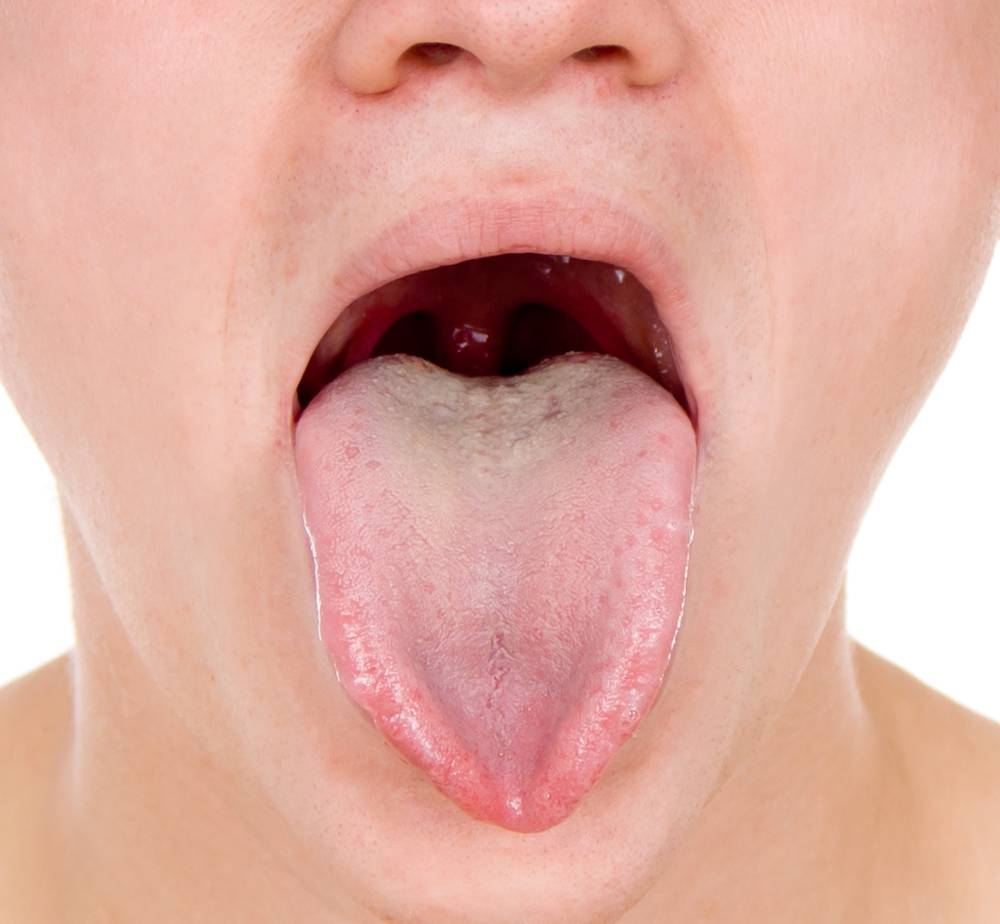 Прыщ под языком на уздечке: белый, фото, причины и лечение