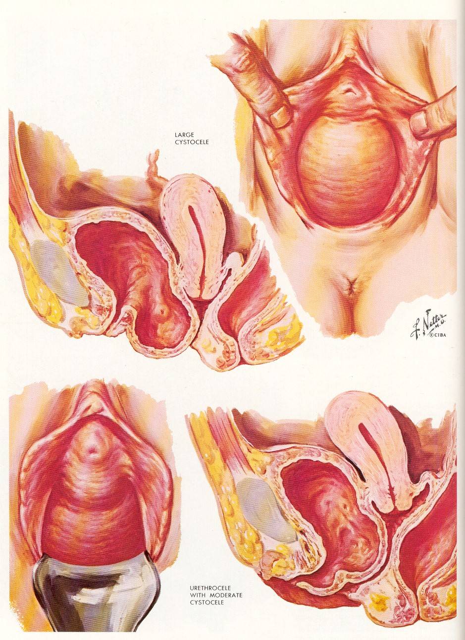 рак матки от спермы фото 60