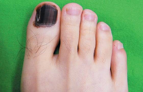 Болезни ногтей: причины деформации и изменения цвета ногтей – напоправку