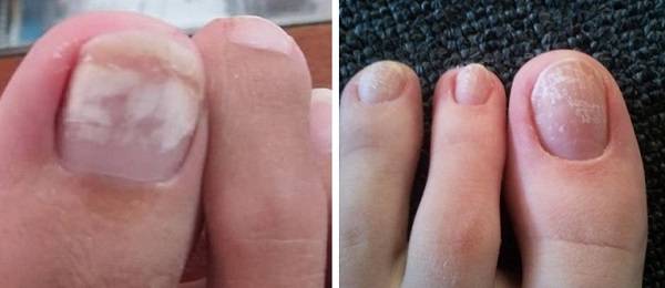 Желтые ногти на ногах причина у женщин лечение