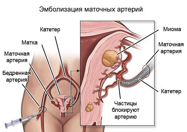 Эмболизация маточных артерий - современный метод лечения миомы матки