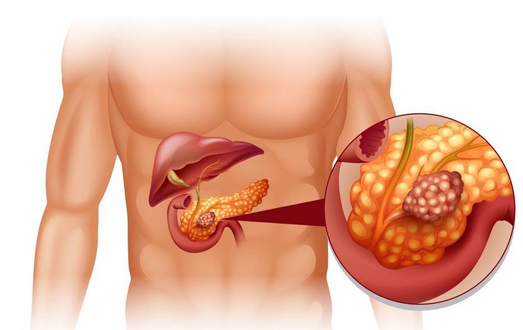 10 признаков симптомов панкреатита поджелудочной железы - press.lv