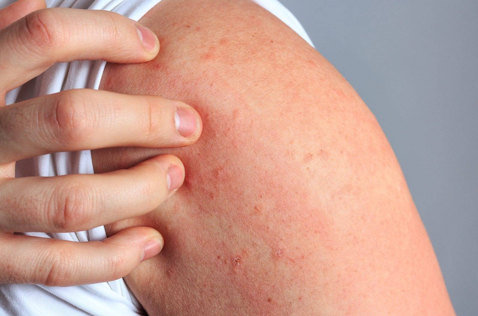 Сыпь на теле у взрослого: как лечить, если чешется, красные высыпания по всему телу и аллергия