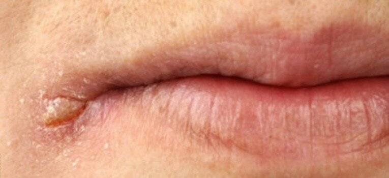 Причины и лечение треснувших губ – чего не хватает в организме
