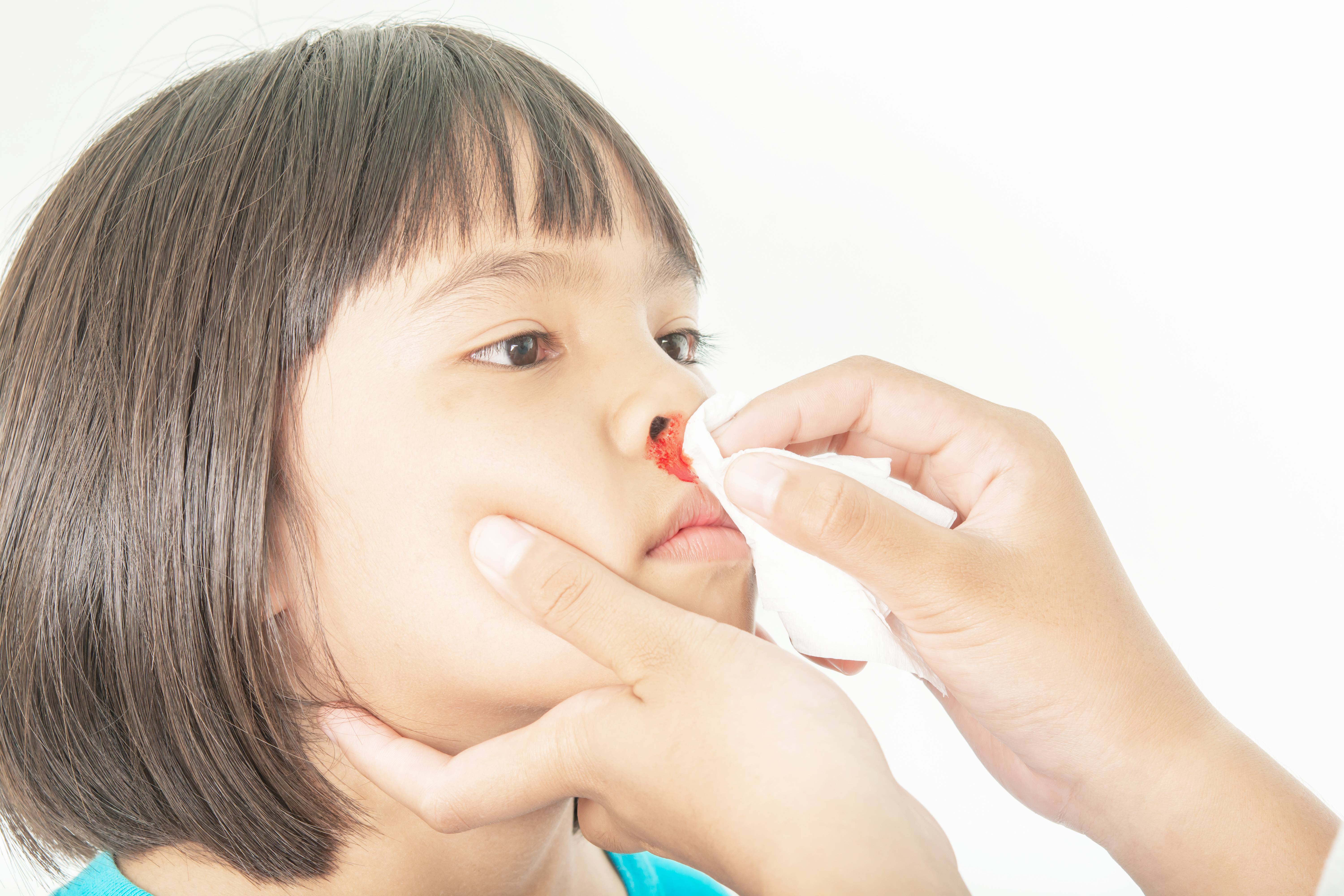 Кровь носом у ребенка 8 лет причины. Нососовое кровотечение. Носовоекровотечениеудетец. Нлсовоеткровоьечение у детей.