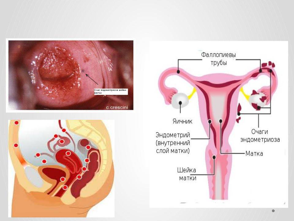 Эндометриоз матки при климаксе: симптомы и лечение у женщин после 50 лет