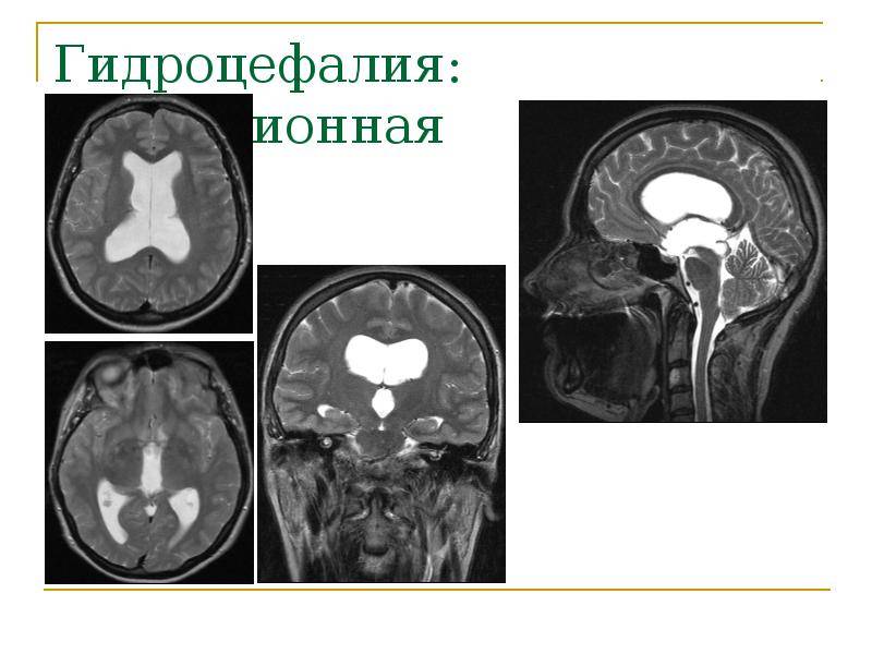 Неокклюзионная гидроцефалия. Внутренняя окклюзионная гидроцефалия мрт. Компьютерная томография головного мозга гидроцефалия. Внутренняя обструктивная гидроцефалия. Гидроцефалия головного мозга на кт.